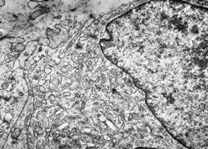 F,81y. | liposarcoma F,81y. | liposarcoma